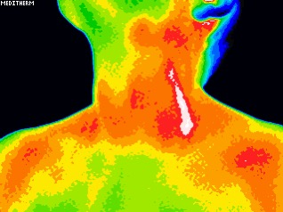 Localized thermography scan of neck region showing temperature differences