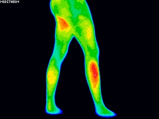 Half body thermogram highlighting heat distribution in legs– Rest ‘N’ Rejuvenate DITI scan example